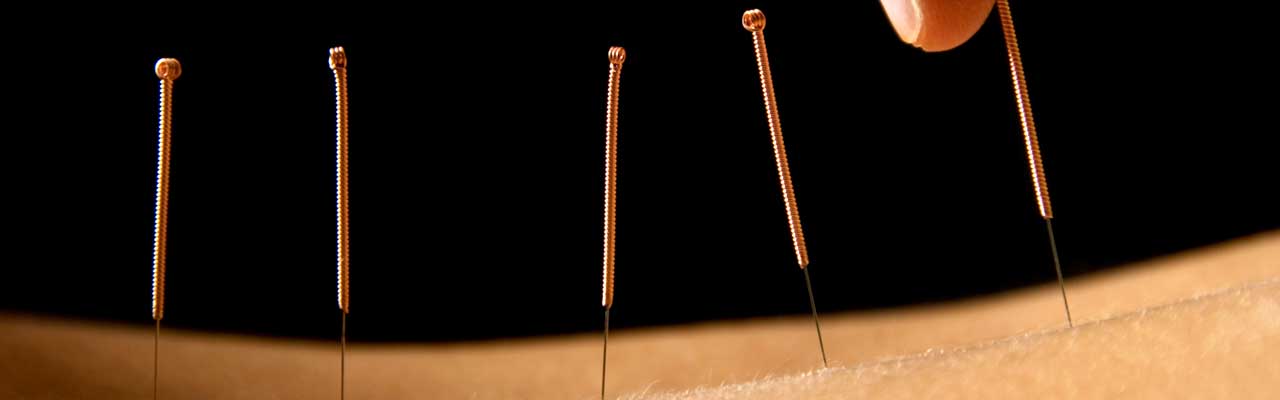 acupuncture needles along spine