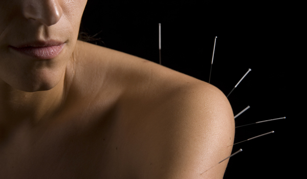 acupuncture pain specialty - needles in shoulder